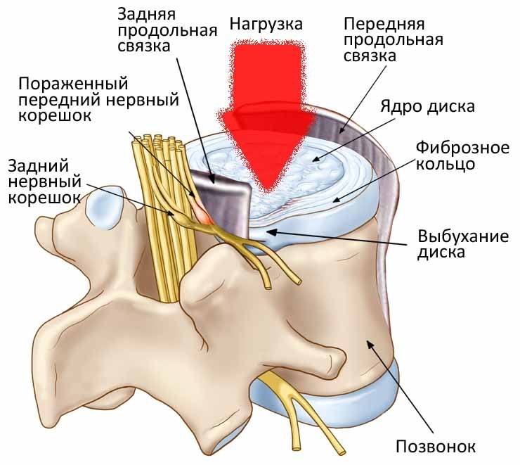 Строение межпозвоночного диска и механизм выбухания