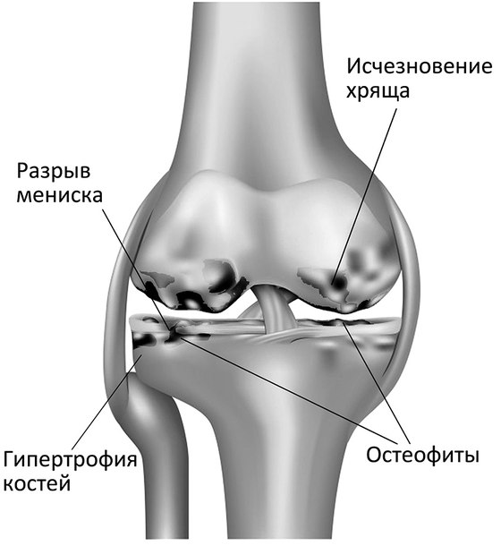 Больной коленный сустав: исчезновение хряща, остеофиты, разрыв мениска