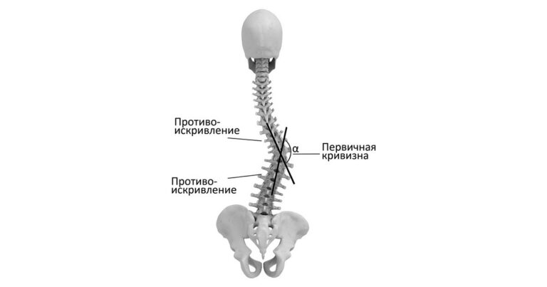 Сколиоз у подростка