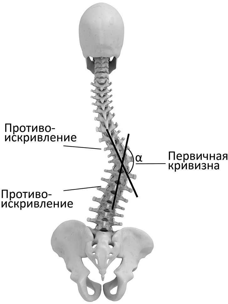 Структурный сколиоз: боковой изгиб со скручиванием позвонков