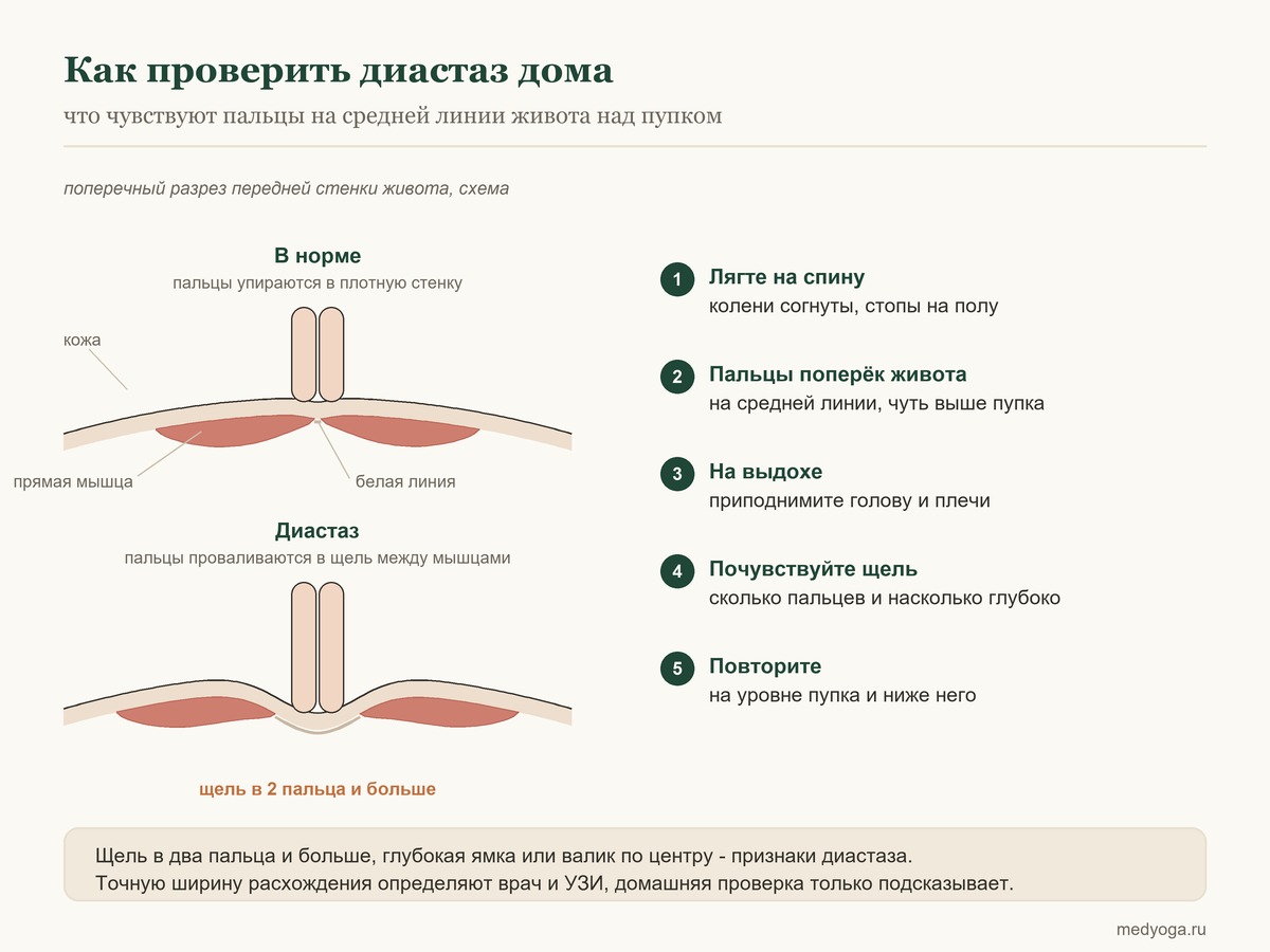 Схема самопроверки диастаза в поперечном разрезе: в норме пальцы упираются в стенку живота, при диастазе проваливаются в щель между мышцами