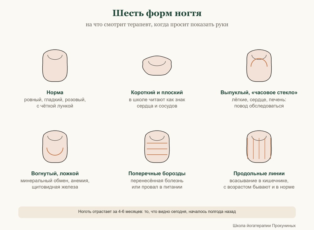 Шесть форм ногтя: норма, короткий плоский, выпуклый «часовое стекло», вогнутый ложкой, поперечные борозды, продольные линии