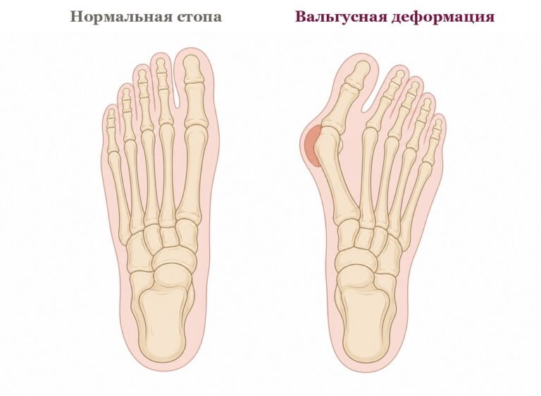 Плоскостопие у взрослых