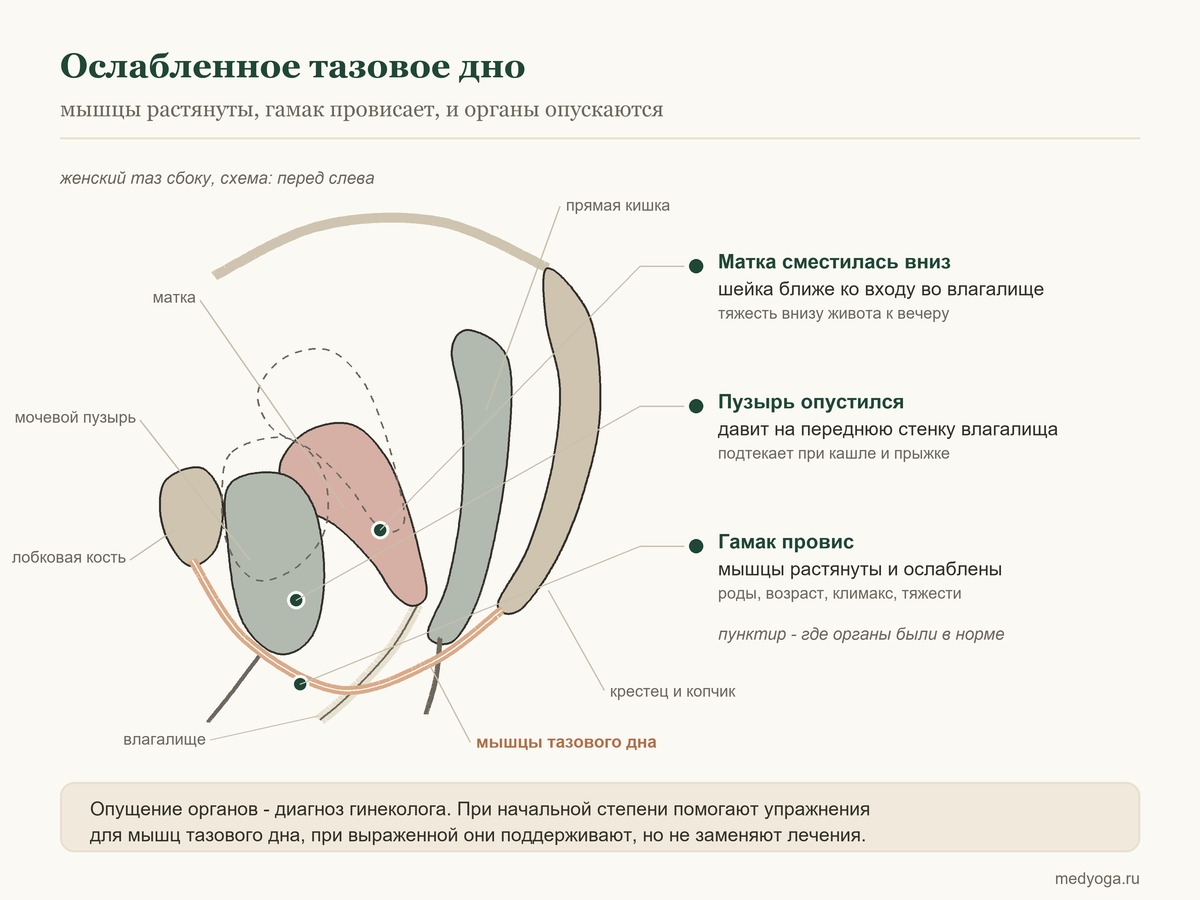 Схема ослабленного тазового дна: мышцы провисли, мочевой пузырь и матка опустились ниже нормального положения
